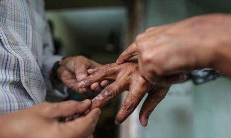 कर्णालीमा घट्दो दरमा कुष्ठरोग
