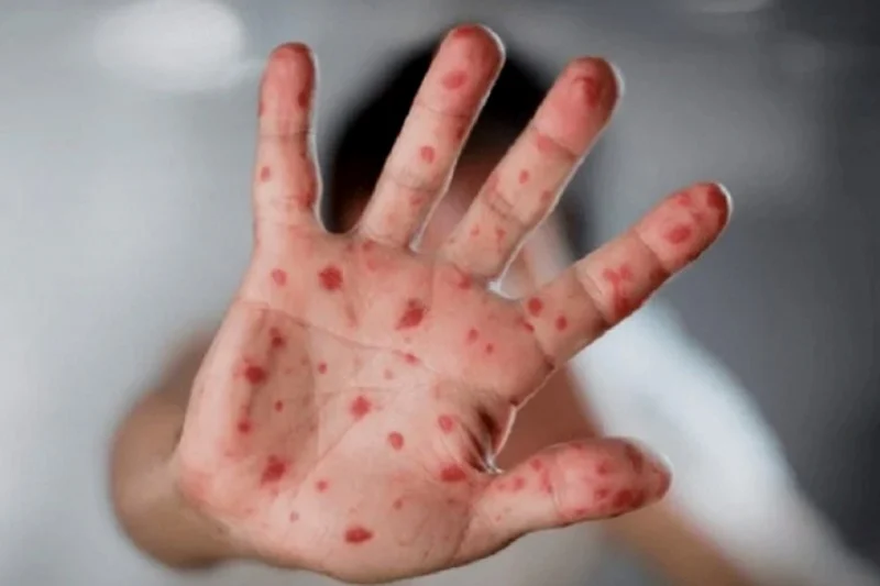 Brazil confirms 2nd case of monkeypox