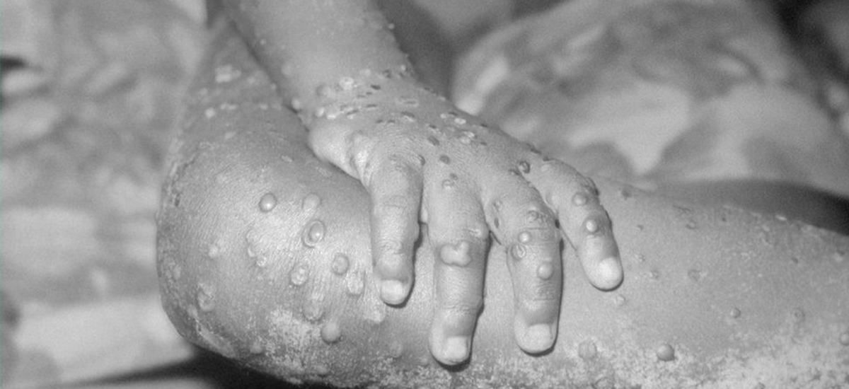 बेलायतमा मङ्कीपक्सका बिरामीको संख्या ५०० नाघ्यो